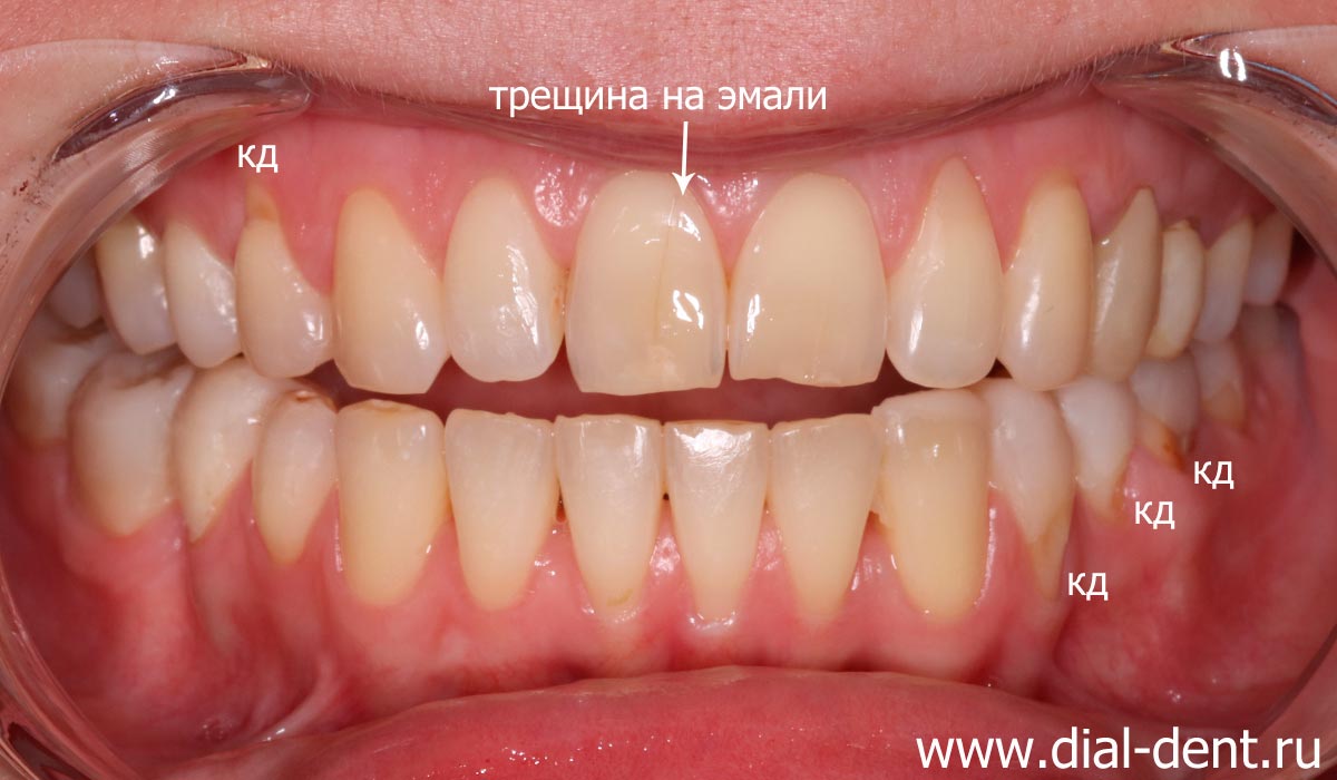желтый цвет зубов, пигментированная трещина на эмали переднего зуба