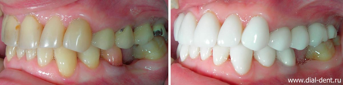вид слева до и после комплексной реставрации зубов