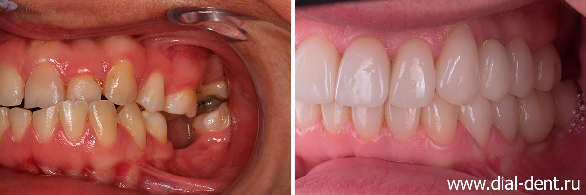 вид зубов слева до и после протезирования керамикой