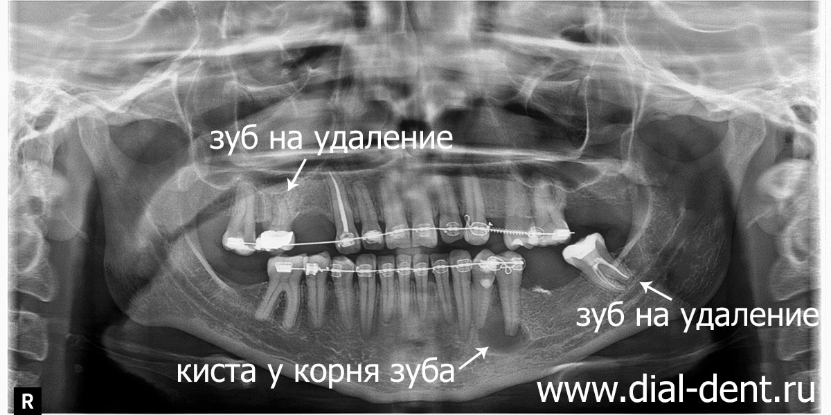 панорамный снимок до лечения и удаления зубов