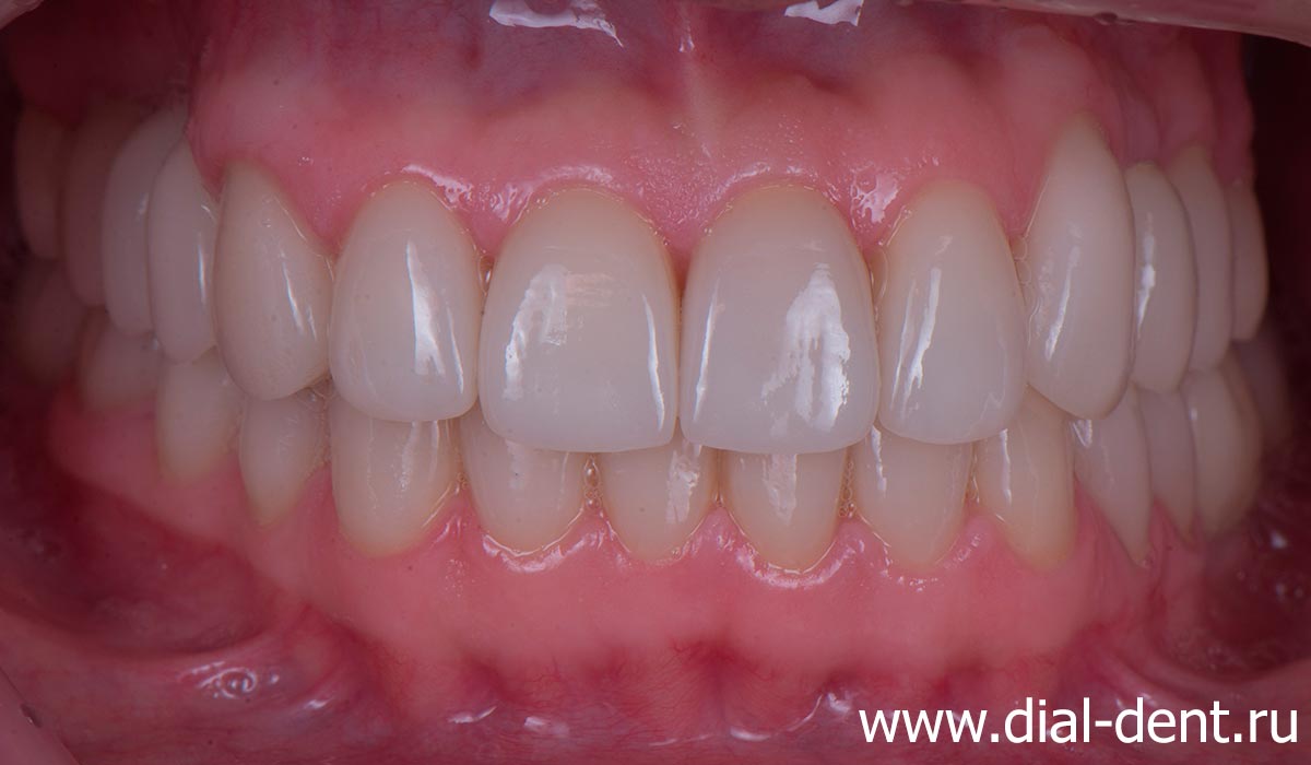 выполнено протезирование всех зубов керамическими коронками (в том числе на 6 имплантах)