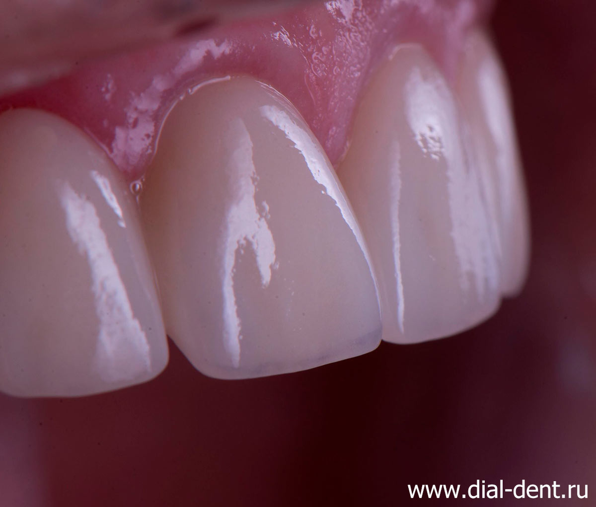 протезирование зубов керамическими коронками