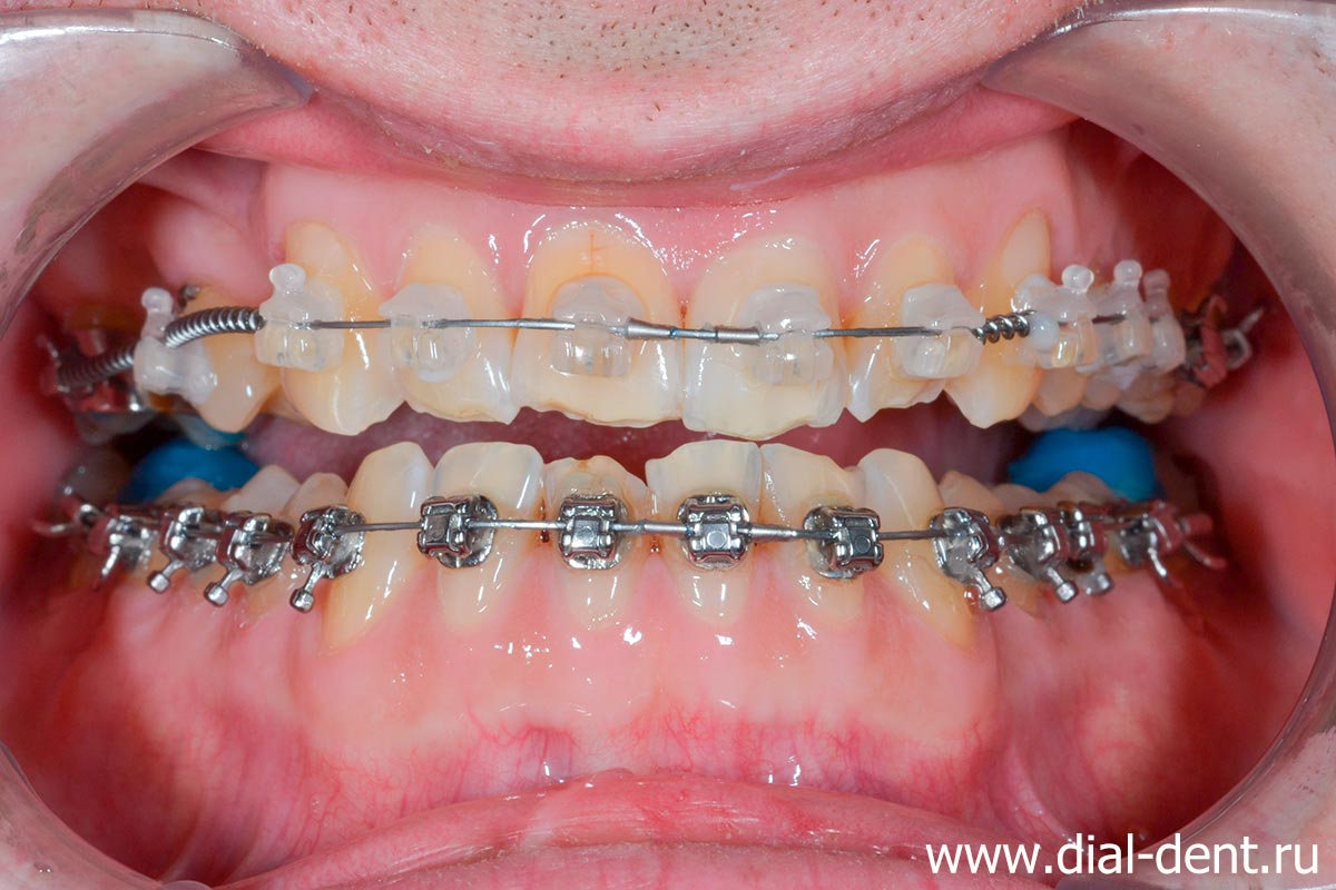 брекеты на зубах и специальные накладки на дальних зубах