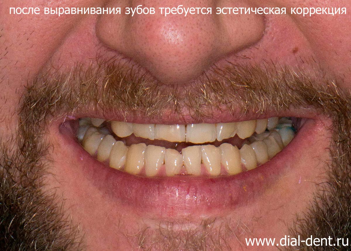 улыбка после снятия брекетов - прикус правильный, но реставрация зубов необходима