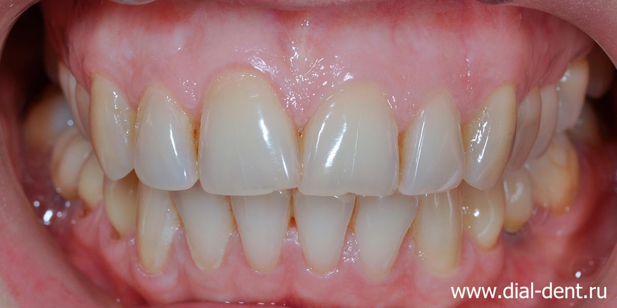 криво растут передние зубы, трещины и сколы на зубах, старые пломбы в жевательных зубах