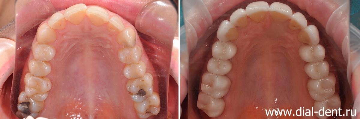 вид верхних зубов до и после протезирования керамикой