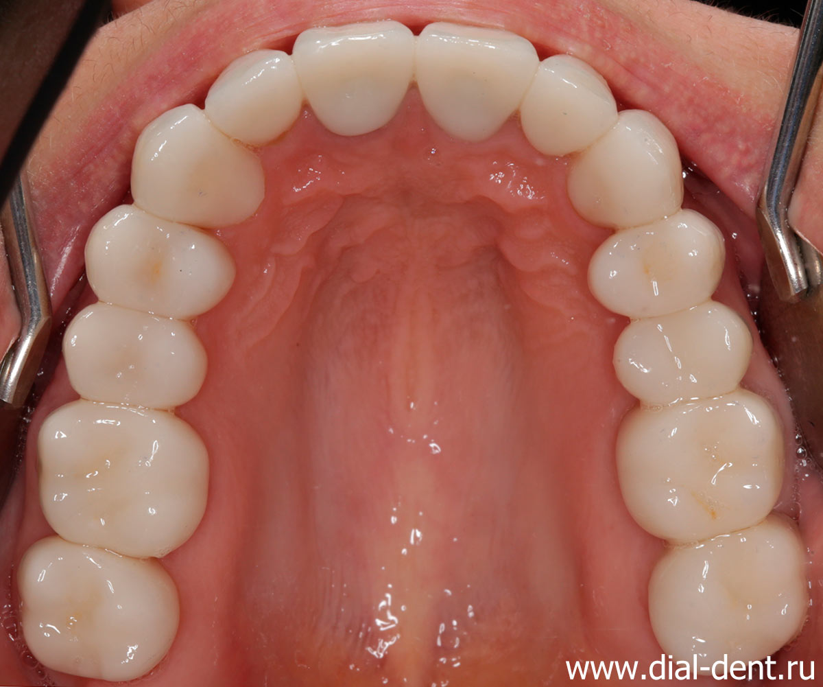  верхние зубы после полного протезирования зубов