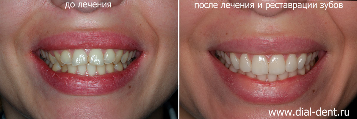 улыбка до и после лечения и реставрации зубов в Диал-Дент