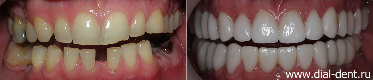 протезирование зубов керамикой с имплантацией, подъемом прикуса и восстановлением эстетики