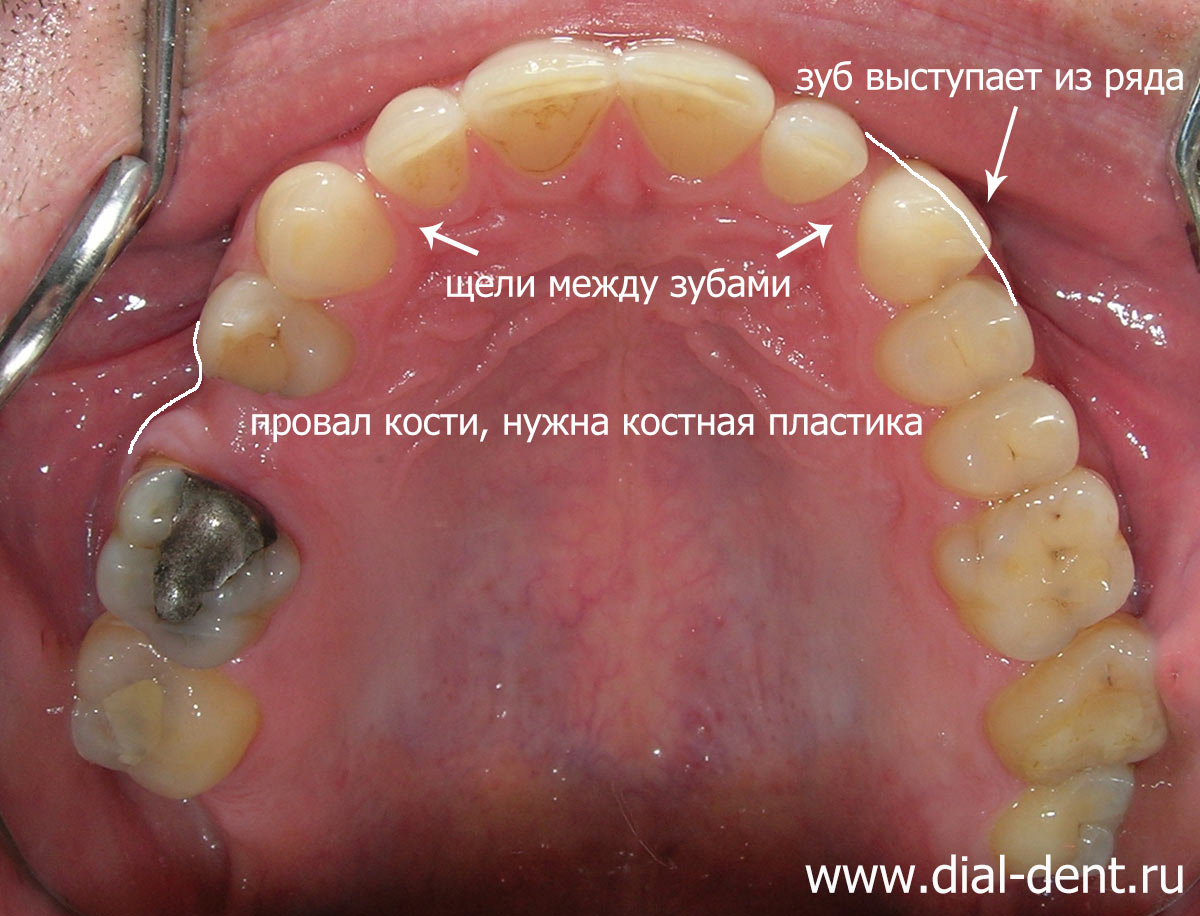 вид верхних зубов до лечения