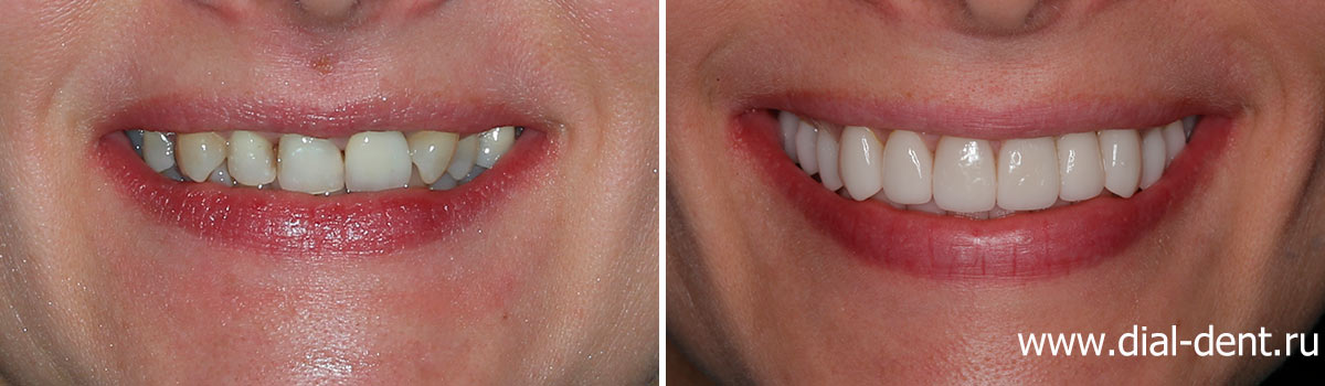 фото улыбки до и после лечения
