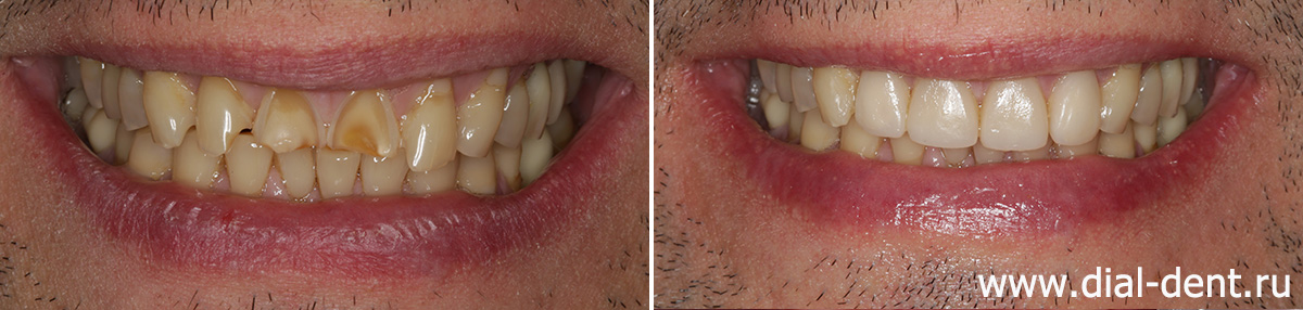 улыбка до и после художественной реставрации 4-х передних верхних зубов