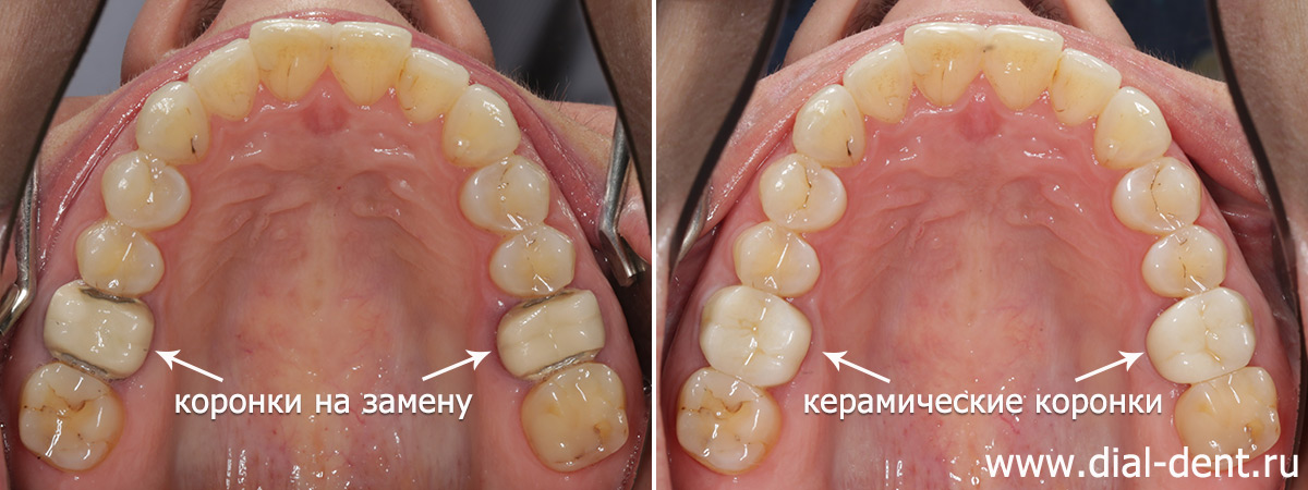 до и после замены коронок на зубах