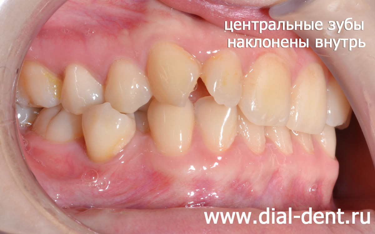 центральные верхние и нижние зубы наклонены внутрь