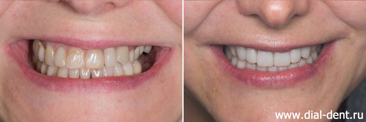 зубы до и после протезирования