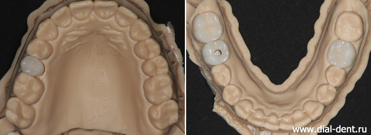 керамические зубные коронки на моделях челюстей в лаборатории