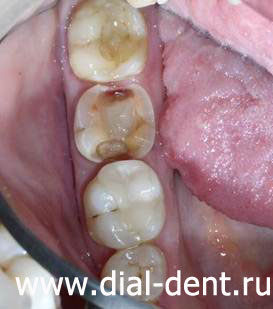 жевательный зуб сильно разрушен кариесом