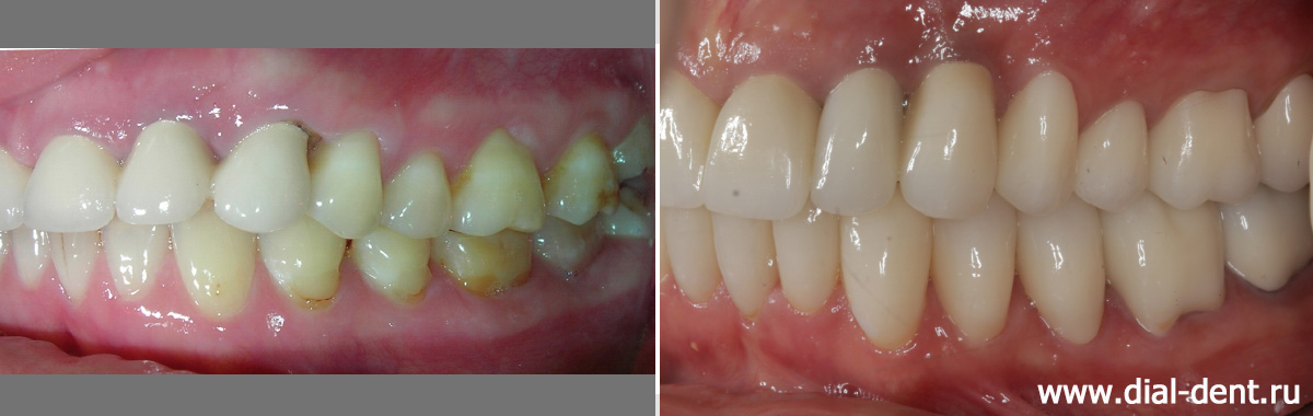 зубы слева до и после имплантации и протезирования
