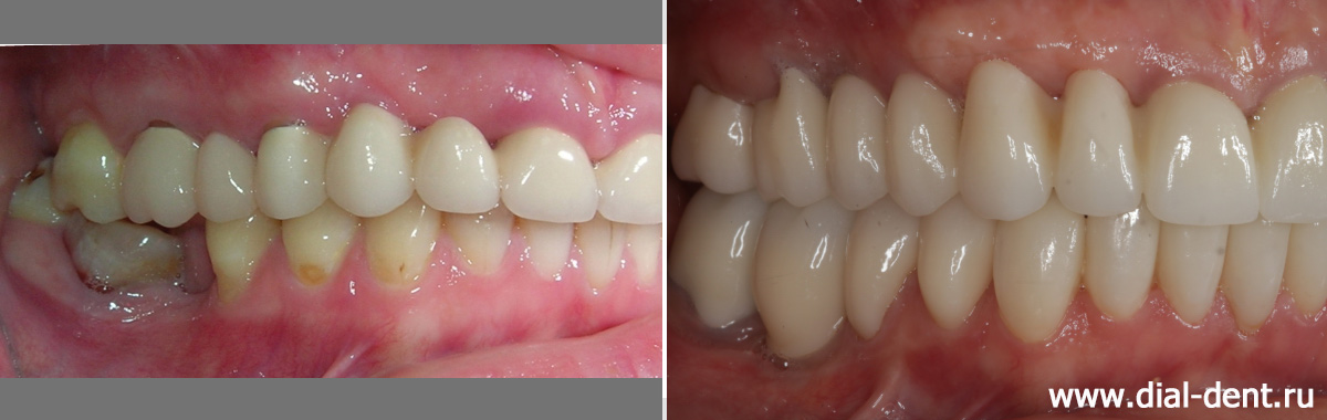 зубы справа до и после имплантации и протезирования