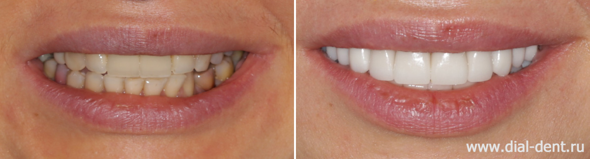 улыбка до и после полного протезирования зубов керамикой
