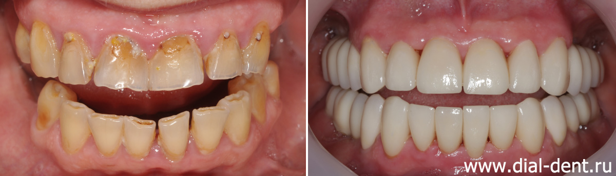 зубы до и после имплантации и протезирования керамикой