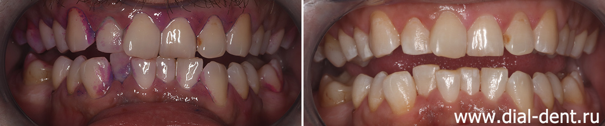 индикация налета и результат профессиональной гигиены зубов