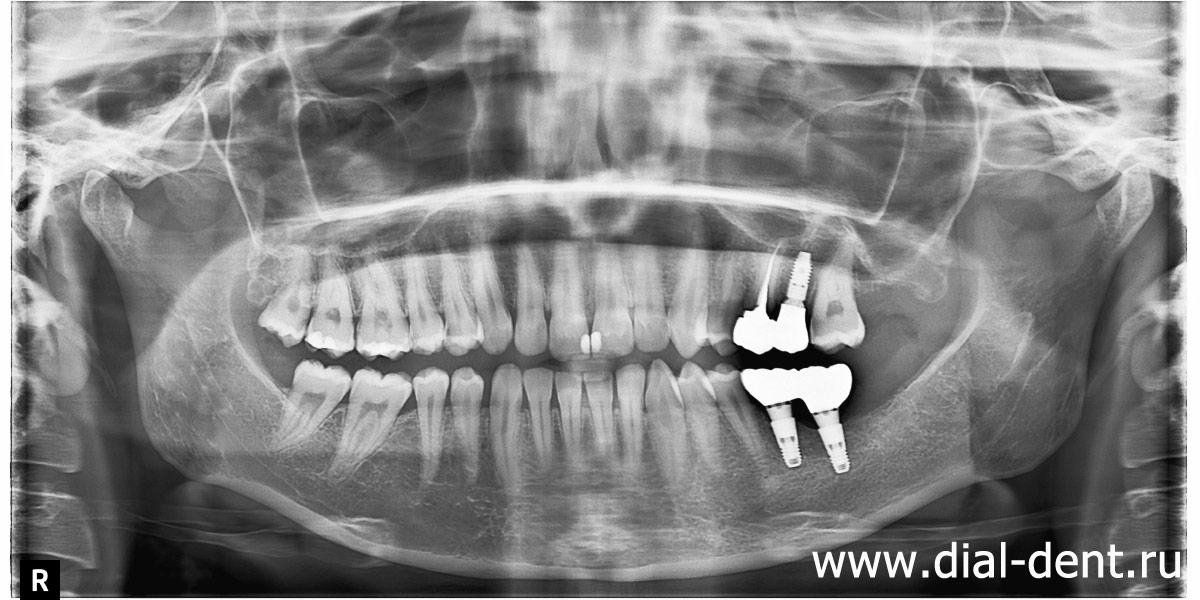 панорамный снимок зубов после имплантации и протезирования 