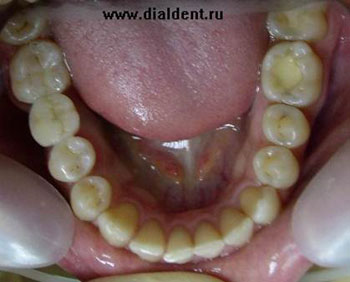 установлен мостовидный протез одного зуба с опорой на вкладки зубные