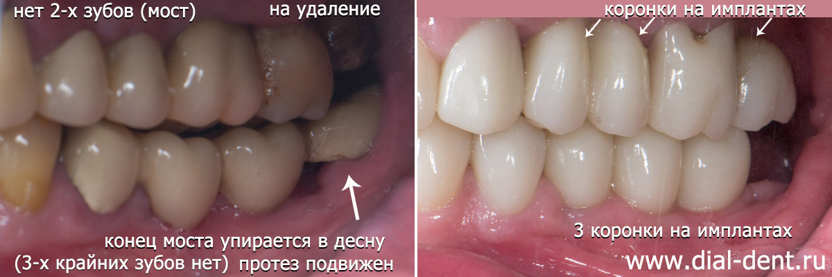 слева до и после лечения
