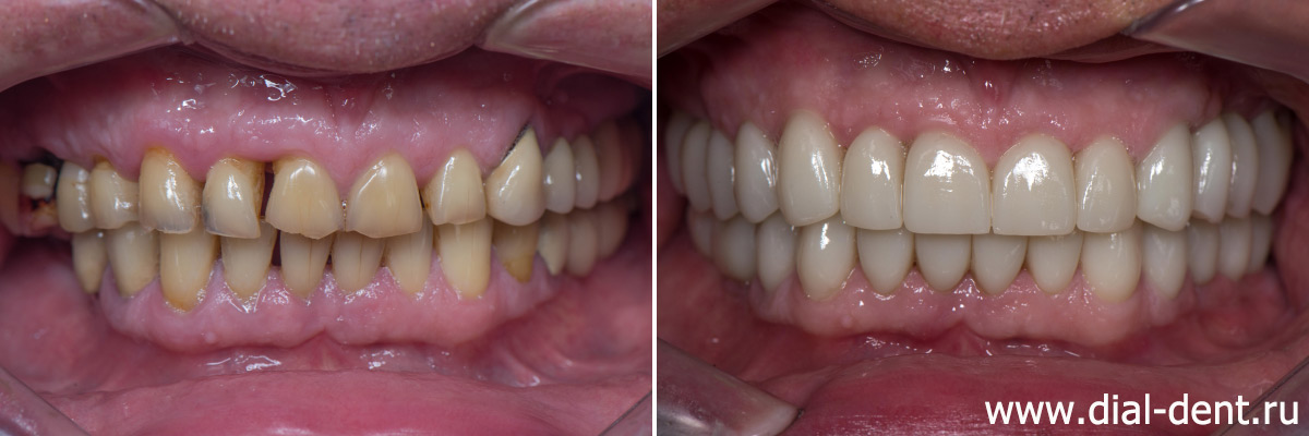 до и после лечения и протезирования зубов в Диал-Дент