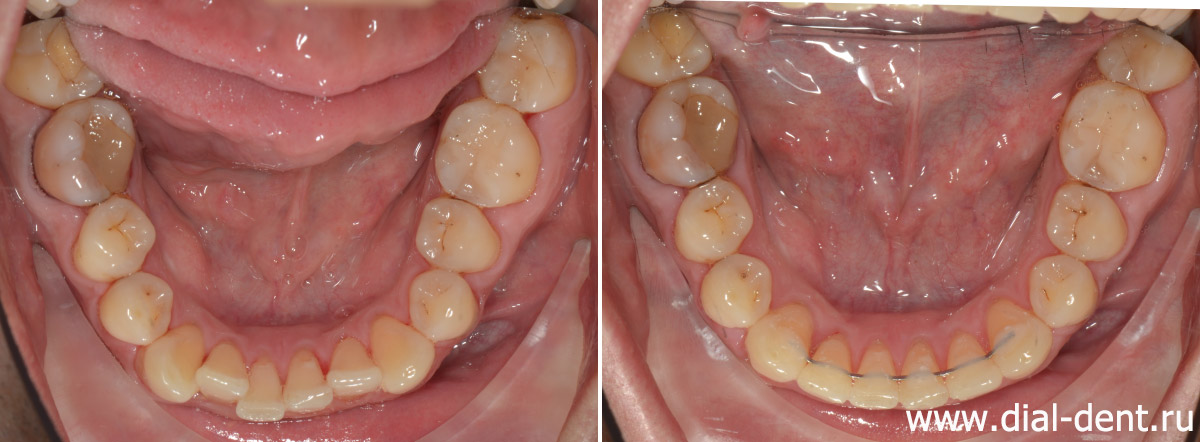 нижние зубы до и после ортодонтического лечения капами 3D Smile