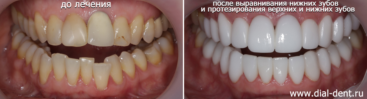 результат протезирования зубов белыми коронками и винирами