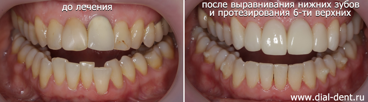 результат протезирования 6 верхних центральных зубов