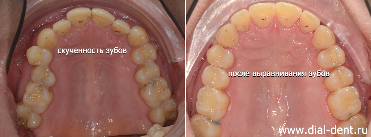 результат лечения брекетами - верхние зубы