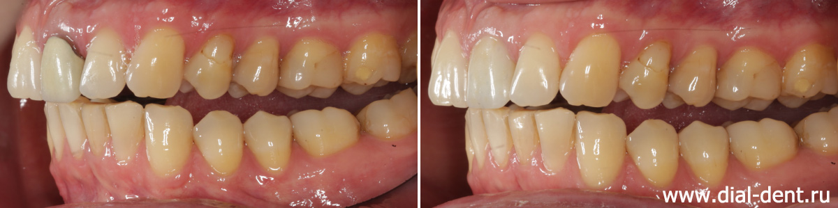 вид слева до и после замены коронки на переднем зубе