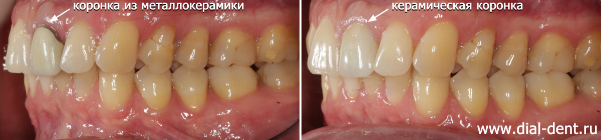 вид слева до и после замены коронки на переднем зубе
