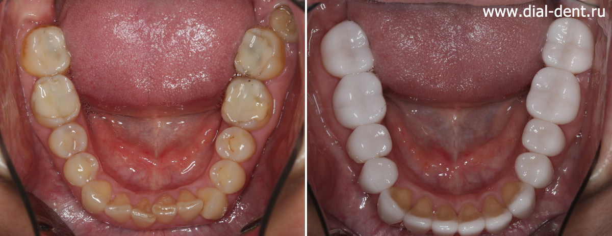 нижние зубы до и после тотального протезирования