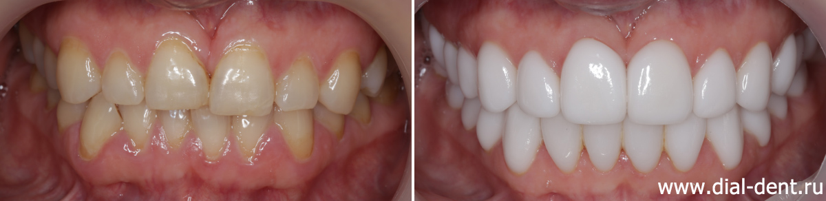 протезирование зубов керамикой в Диал-Дент - вид до и после