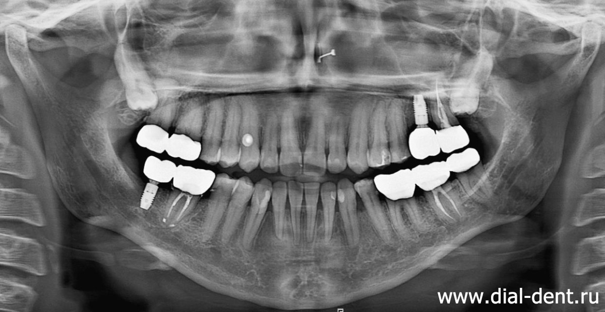 снимок зубов после лечения