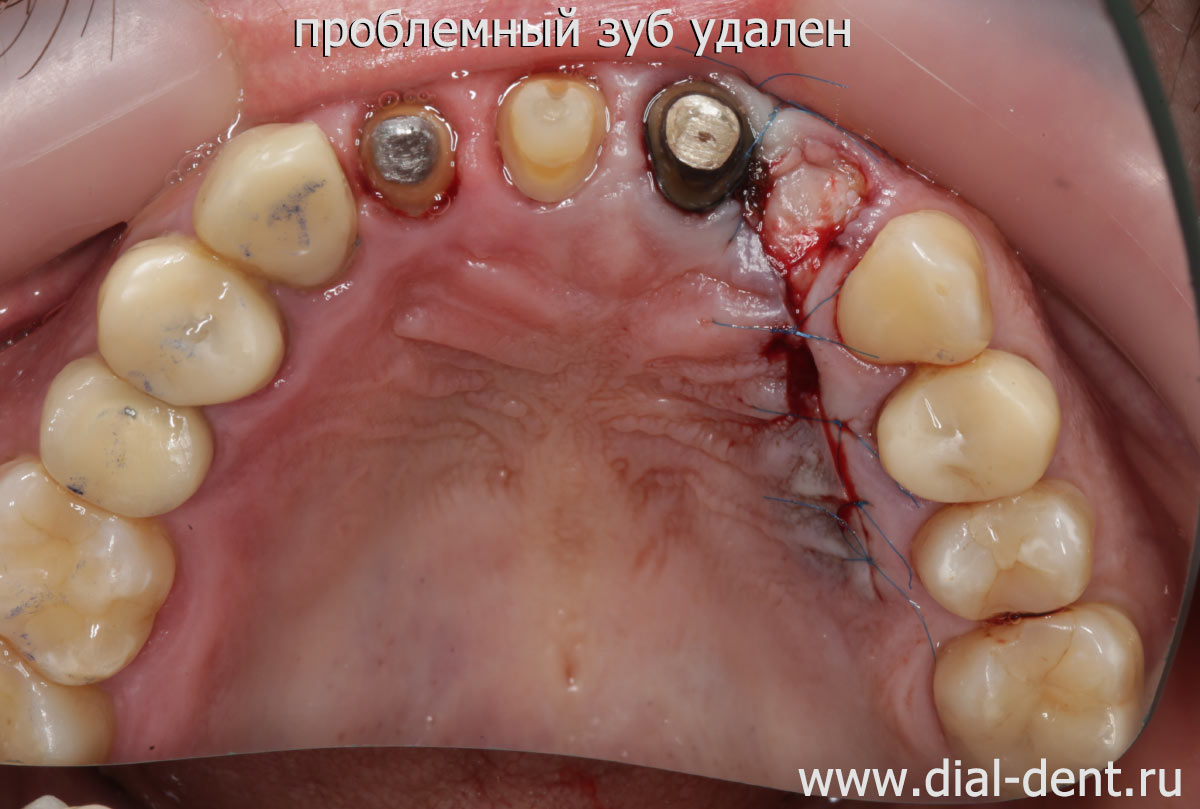 зуб удален, зона воспаления вычищена, наложены швы