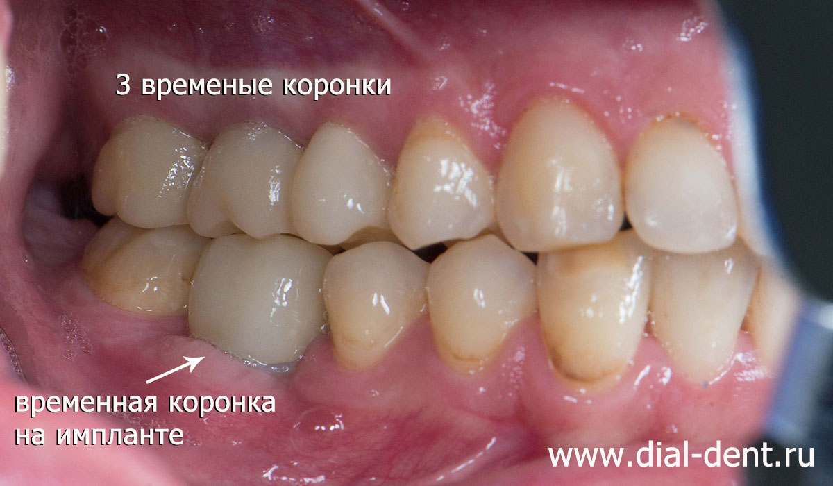 этап протезирования зубов