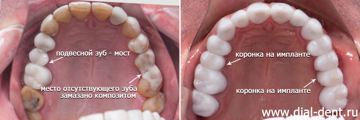 до и после полного протезирования зубов в Диал-Дент