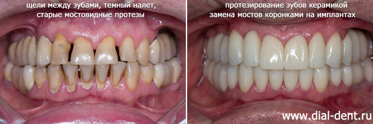 вид зубов до и после протезирования в Диал-Дент