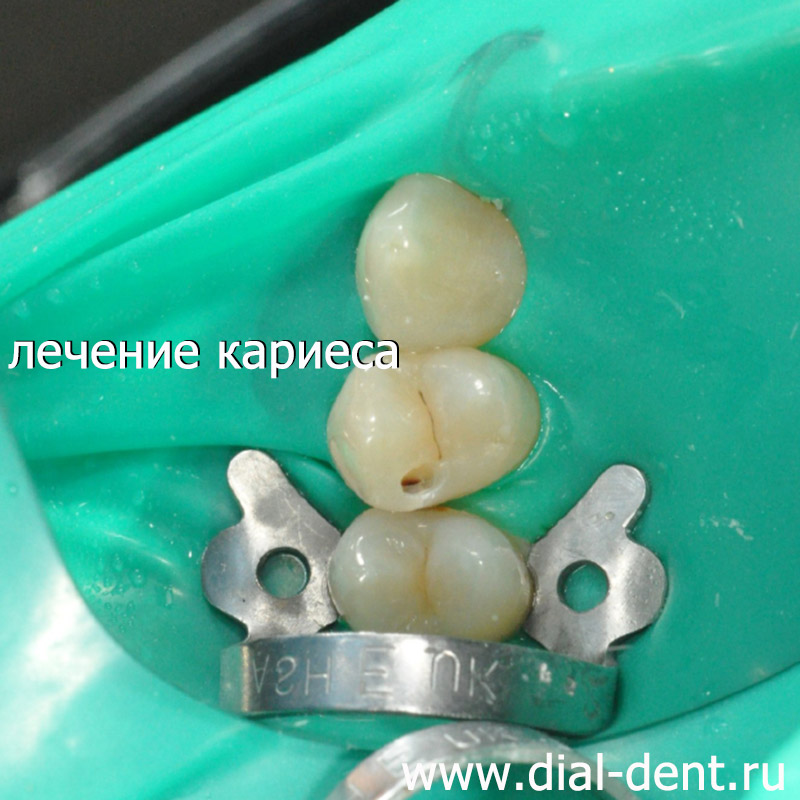 лечение кариеса зубов в Диал-Дент