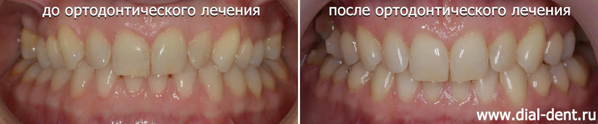 до и после ортодонтического лечения капами