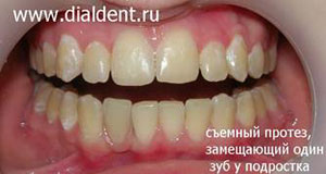 съемный протез на зубах
