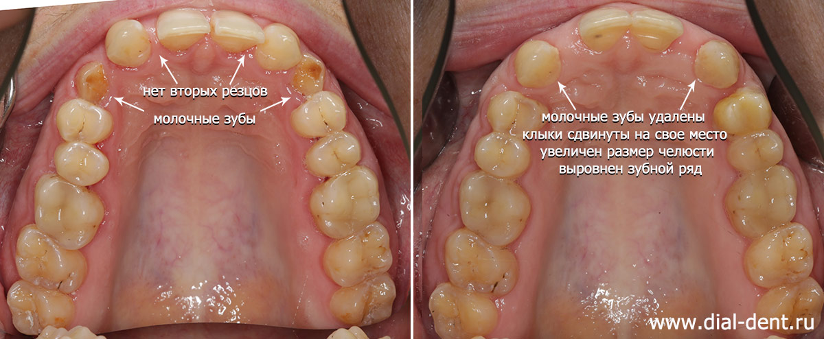 до и после ортодонтической подготовки к протезированию зубов