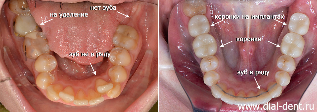 до и после комплексной подготовки и протезирования зубов