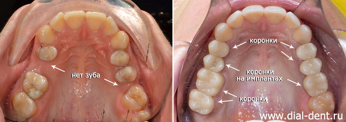 до и после комплексной подготовки и протезирования зубов