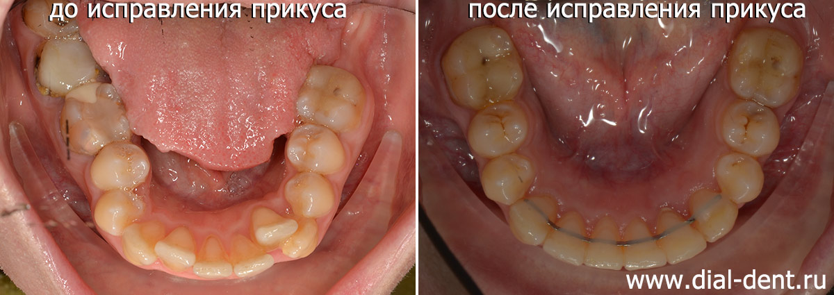 до и после исправления прикуса нижние зубы